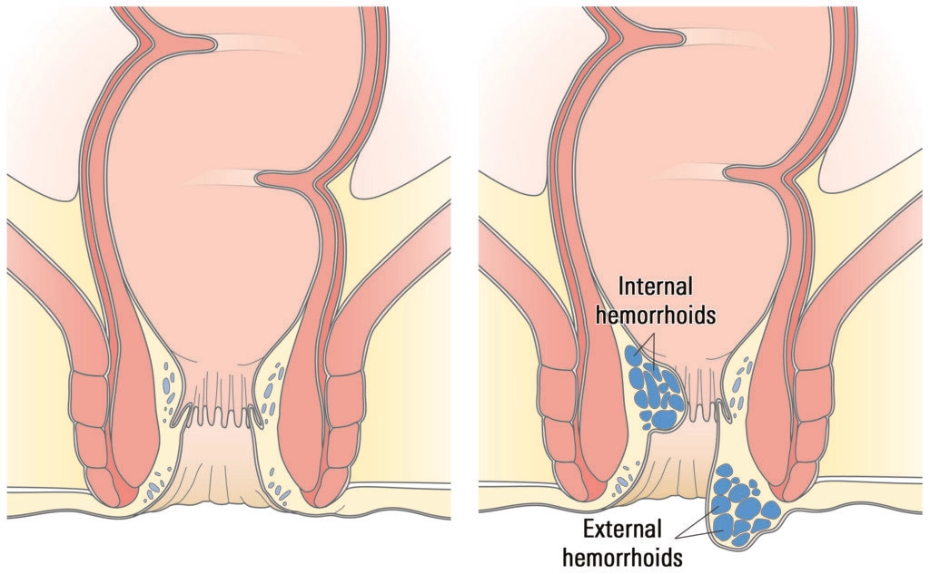 How to shrink hemorrhoid skin tag – Explain