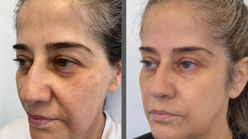 Why Morpheus8 Is the Best Choice for Non-Surgical Anti-Aging