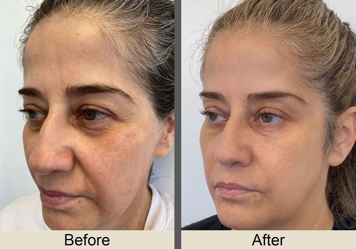 Why Morpheus8 Is the Best Choice for Non-Surgical Anti-Aging